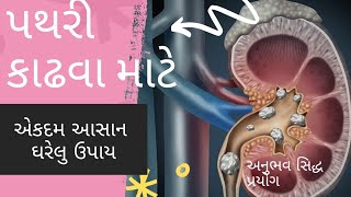 પથરી નો દુખાવો | પથરી નો ઇલાજ | પથરી ની આયુર્વેદિક દવા | #stone