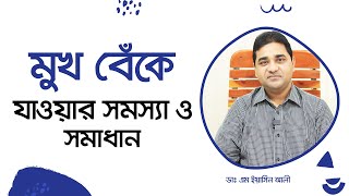 মুখ বেঁকে যাওয়ার কারন কি? চিকিৎসা কি ? সমাধান জেনে নিন। (4k)