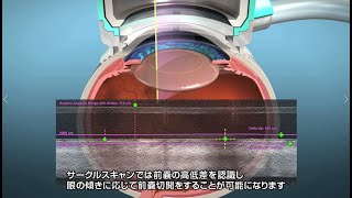 レーザー白内障手術なら1000分の1㎜単位で水晶体前嚢を切開できる  大宮七里眼科