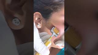 Why You Really Need DERMA ROLLER TREATMENT FOR ACNE SCARS | Viral #shorts