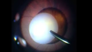 Traumatic dislocated white cataract. Vitrectomy and Fragmatome Lensectomy