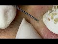 lager open pores on face treatment acne treatment nguyỄn lan 026