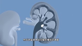 这才是科学治病，尿道镜肾结石取石过程，3D演示。。