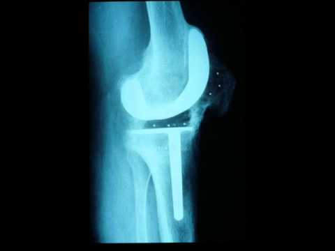 MATERIAL DE OSTEOSINTESIS EN IMAGENES RADIOLOGICAS - YouTube