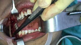 Mandibular Osteotomy in South India - video by Dr Sunil Richardson, BSSO