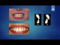 inbde practice questions prosthodontics week4