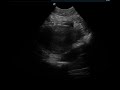 Double Bladder Sign -- Three Cases of an Ultrasonographic Sign that Indicates Ovarian Torsion