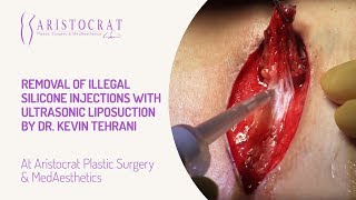 Removal of Illegal Silicone Injections with Ultrasonic Liposuction by Dr. Kevin Tehrani