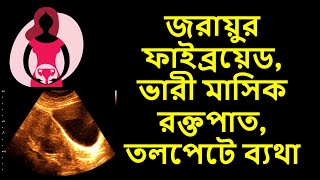 জরায়ুর ফাইব্রয়েড | ভারী মাসিক রক্তপাত | তলপেটে ব্যথা | কি কি করনীয়