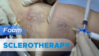 What is Foam Sclerotherapy?