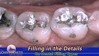 Smilecast: Filling in the Details on Fillings