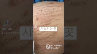 임신튼살관리플라즈마블라스트 01052072669 문자주세요^^ #shorts #skincare #shortvideo