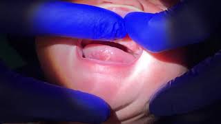 Deeper Stretch After Tongue and Lip-Tie Release- Alabama Tongue-Tie Center