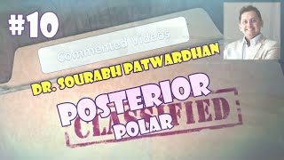 Commented 10: Posterior polar cataract at 50cm IOP Dr Sourabh Patwardhan