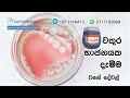 ස්ථීර කෘතීම දත් ඇඳි සිටවීම් සහිත දත් ඇඳි ගැලවෙන්නෙ නැති දත් ඇඳි implant supported overdentures