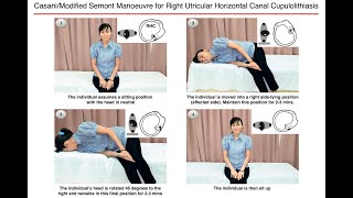 Casani/Modified Semont Manoeuvre for Right Utricular Horizontal Canal Cupulolithiasis