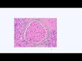 membranous nephropathy