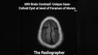 Colloid Cyst Unique Case MRI Brain | #mri #mribrain #CYST #colloid #medicalimaging