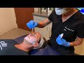 applying emla numbing cream at home before your microneedling appointment