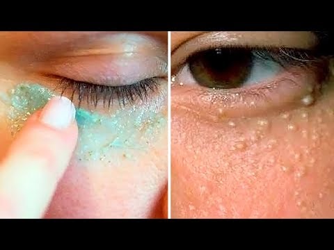 How To Get Rid of Milia at Home - Safe, Easy & Scar Free How To Get Rid of Milia at Home - Safe, Easy & Scar Free