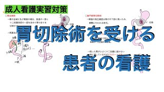 ［成人看護実習対策］胃切除術を受ける患者の看護