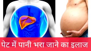 पेट में पानी का इलाज | पेट में पानी भरा जाने का कारण लक्षण इलाज़ | ASCITES CAUSE sign symptoms Rx