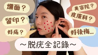 【Vlog】脫疣一星期記錄㊙️ 好後悔⋯要爛面一星期❓ 激光痛嗎😭 治療後分享❤️