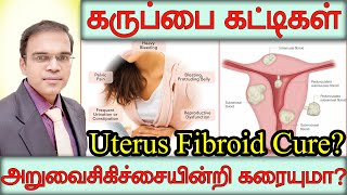 Uterine Fibroids Cure without surgery கருப்பை கட்டிகளை அறுவை சிகிச்சை இல்லாமல் சரி செய்ய முடியுமா?