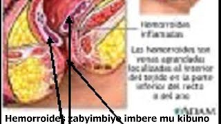 INDWARA YA HEMORROIDES (KARIZO): NGIYI IMITI IYIVURA NEZA: NI IMIRIRE: IMBOGA, IMBUTO N'IBINYAMPEKE