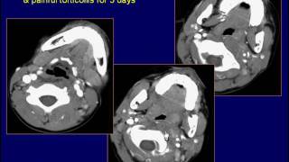 Neuroradiology Case 46