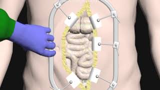 Lumbar Spinal Exposure using the Retroperitoneal Technique (ALIF Part 2) Animation Cal Shipley, M.D.