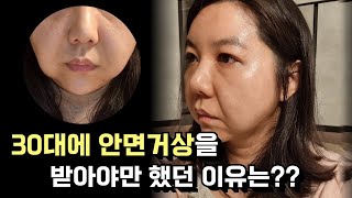 Conventional Facelift Surgery Review in 30s | Getting Rid of Jowls, Double chin, Laugh lines, Eyebag