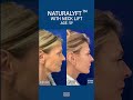 59 year old Facelift & Neck lift transformation