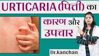 Urticaria (पित्ती )क्या है और  क्यों होती है? | पित्ती का इलाज