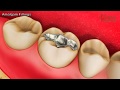 What are Amalgam Fillings? When is it used?