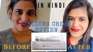 Triluma review in hindi | best cream to treat hyperpigmentation | hyperpigmentation problem on face