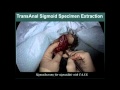 SS11 Flexible Endoscopy II: S056 TRANSANAL OR TRANSABDOMINAL SPECIMEN EXTRACTION