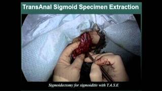 SS11 Flexible Endoscopy II: S056 TRANSANAL OR TRANSABDOMINAL SPECIMEN EXTRACTION