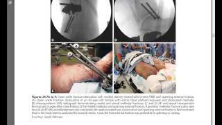 Ankle fx and syndesmotic injuries book chapter review