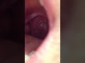 How to Remove Tonsil Stones How to Remove Tonsil Stones
