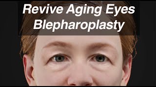Blepharoplasty (Eyelid Surgery) to Revive Aging Eyes and Look Years Younger