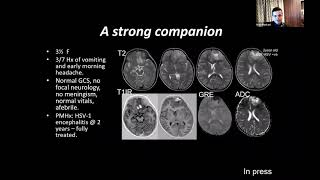 Kshitij Mankad, MD, FRCR. Pediatric Neuroradiology- Neuroinflammation.