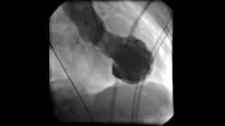 Left Ventricular Angiography.