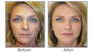 How To Get Natural Looking Botox Results