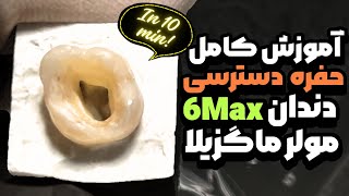 access cavity of upper 6 step by step/تهیه حفره دسترسی مولر بالا