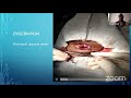 evisceration enucleation and exenteration