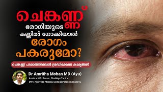 ചെങ്കണ്ണ് രോഗിയുടെ കണ്ണില്‍ നോക്കിയാല്‍ രോഗം പകരുമോ? | Conjunctivitis | Dr Amritha Mohan MD (Ayu)