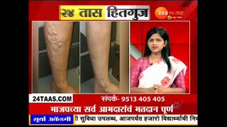 Namma Homeopathy Dr Reena Varicose veins