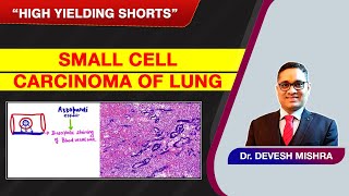 High Yielding Shorts-94 (#HYS-94):Small cell carcinoma of Lung by Dr Devesh Mishra