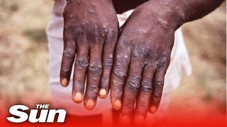 Monkeypox outbreak doubles as a further UK 11 cases identified